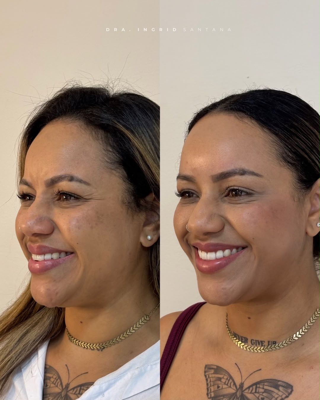 Antes e depois de paciente, resultado 1