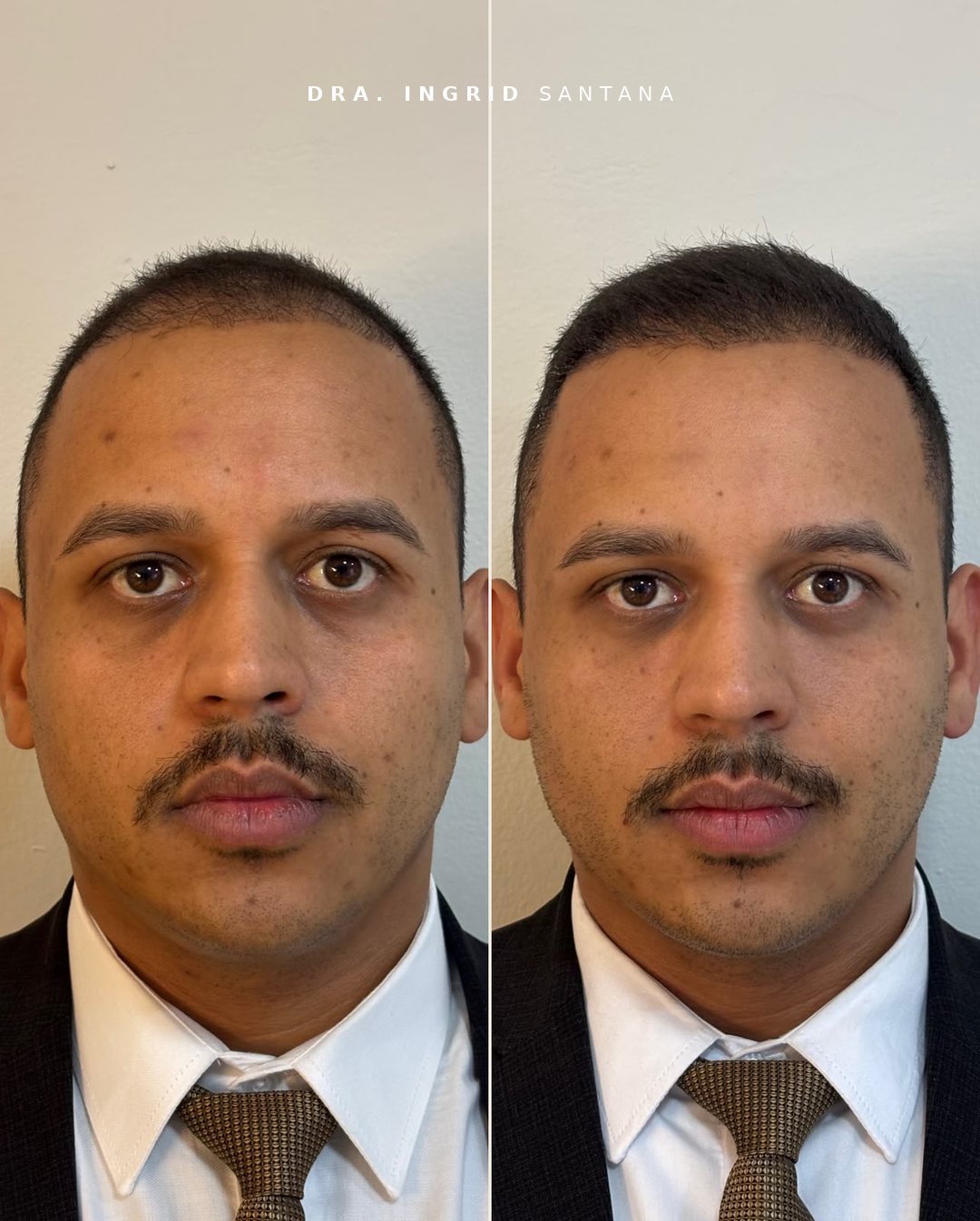 Antes e depois de preenchimento de olheiras