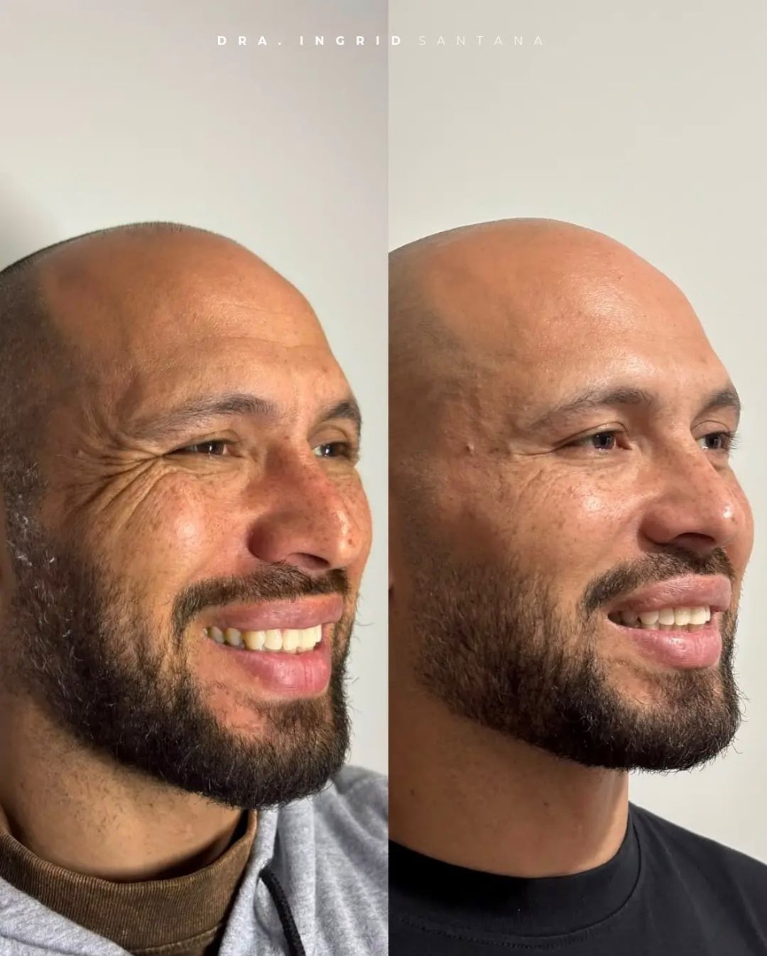Antes e depois de paciente, resultado 2