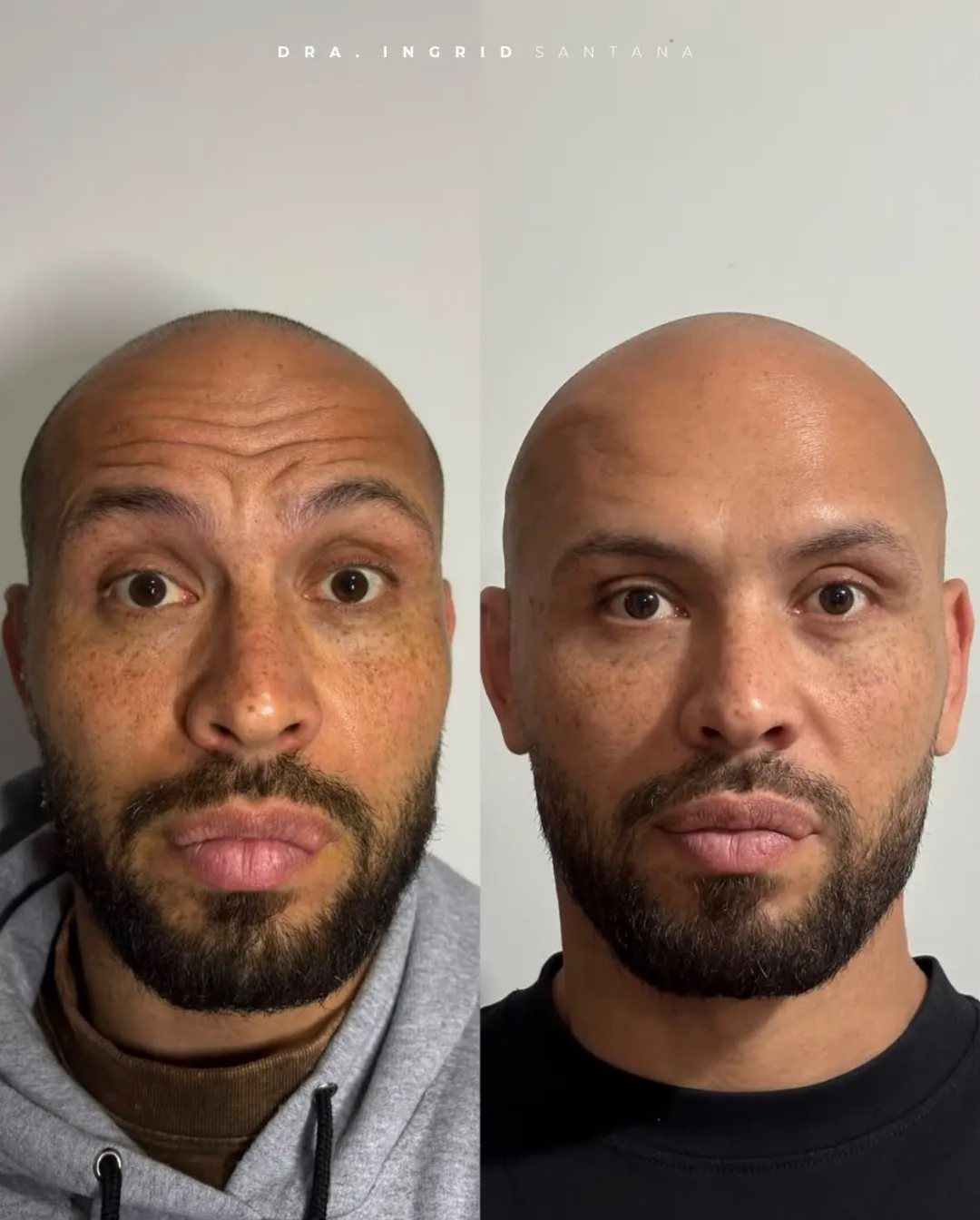 Antes e depois de paciente, resultado 3