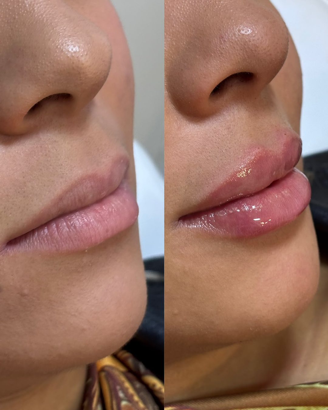 Antes e depois de paciente, resultado 4