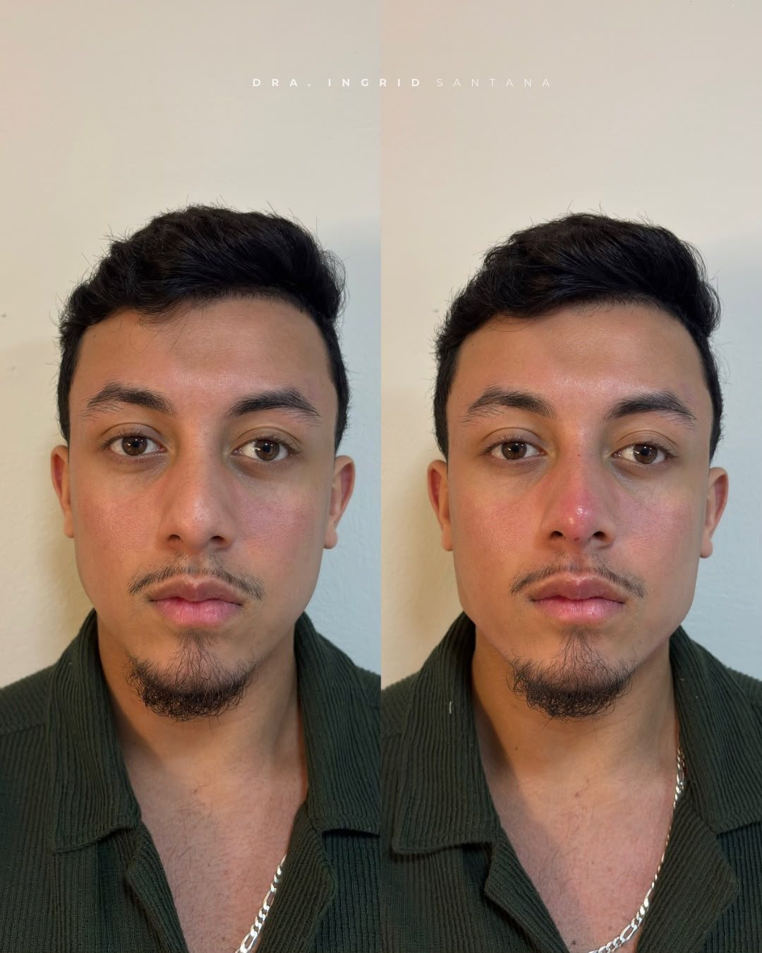 Antes e depois de paciente, resultado 5