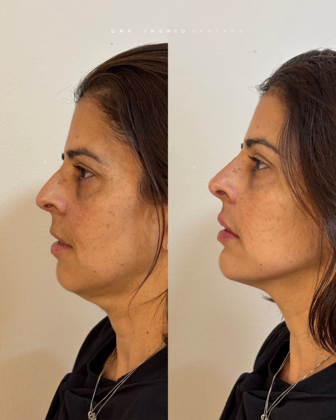 Antes e depois de paciente, resultado 6