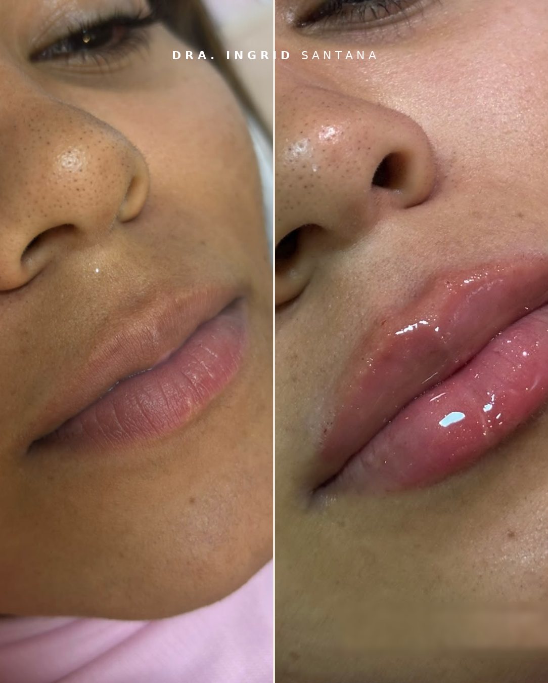 Antes e depois de preenchimento labial